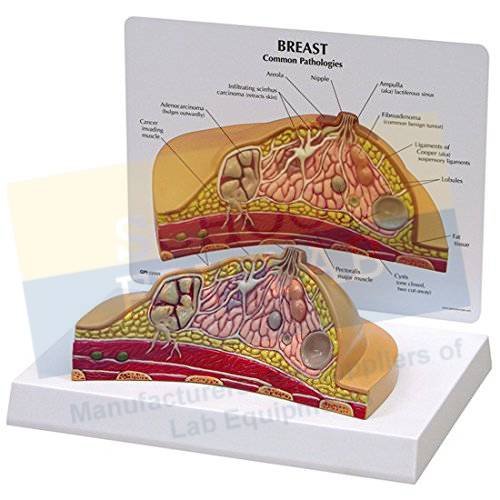 Breast Cancer Model